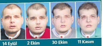 Dünyanın en başarılı yüz nakli
