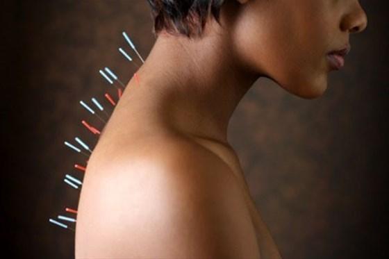 Depresyon için etkili çözüm: Akupunktur