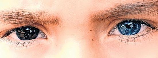 Hüseyin’in bir gözü mavi diğeri kahverengi