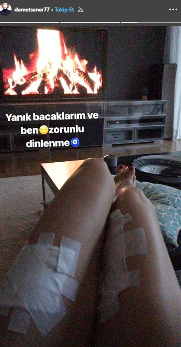 Demet Şener yanık bacaklarının fotoğrafını paylaştı