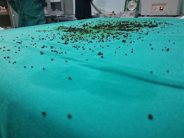 Safra kesesinden 3 bin 765 tane taş çıktı