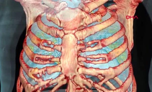 Koronavirüs bulunan akciğerin 3D görüntüsü yayınlandı