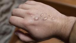 Maymun çiçeği virüsü, anne karnındaki bebeğe ulaşabilir