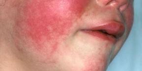 Kızıl hastalığı nedir, bulaşıcı mıdır? Kızıl hastalığının belirtileri nelerdir, aşısı var mı, tedavisi nedir, nasıl geçer?