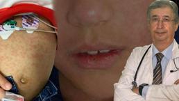 Yıllardır görülmeyen vakalar ortaya çıktı uzman isimden salgın uyarısı geldi