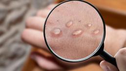 Maymun çiçeği virüsü nedeniyle 2 kişi karantinaya alındı