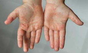 El ayak hastalığı neden olur, ne iyi gelir?