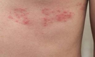 Zona hastalığı tehlikeli midir, bulaşıcı mıdır? Zona hastalığı tedavi edilmezse öldürücü müdür?