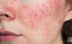 Gül hastalığı olanlar nelere dikkat etmeli?