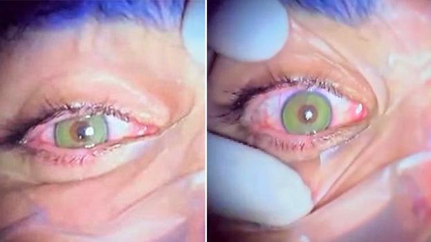 Göz rengini değiştirmek bir ameliyatla mümkün! Lazer destekli yeni yöntemler kalıcı sonuç veriyor