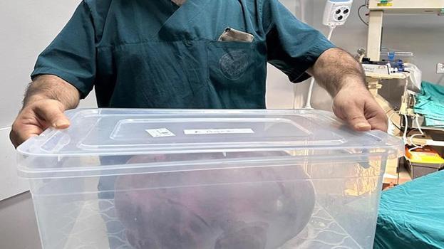 Trabzon'da kadının yumurtalıklarından çıkan kitle doktorları bile şoke etti! 9 kilo ağırlığında 40 santim uzunluğunda
