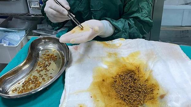 Karın ağrısı şikayetiyle gitti safra kesesinden çıkanlar şaşkına çevirdi! Tam 2 bin 67 adet
