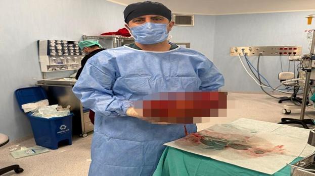 Karın ağrısı şikayetiyle hastaneye gitti! Doktorlar bile gözlerine inanamadı: Tam 8 kilo
