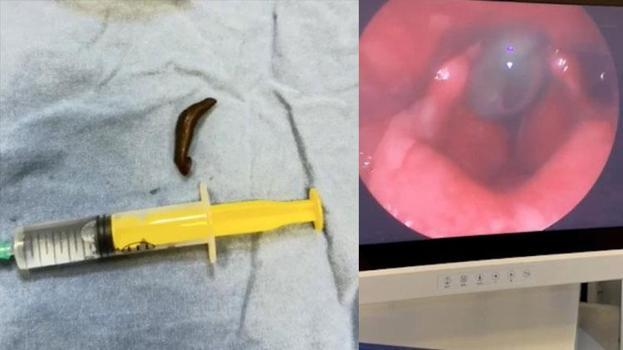 Vatandaşın boğazından çıkan canlı doktorları şoke etti: İlk defa gördüm
