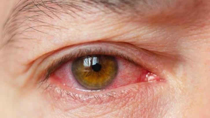 Kırmızı göz hastalığı bulaşıcı mı, neden olur, ölümcül müdür? Pakistan kırmızı göz hastalığı nedir? Kırmızı göz hastalığı (konjonktivit) iyileşme süresi