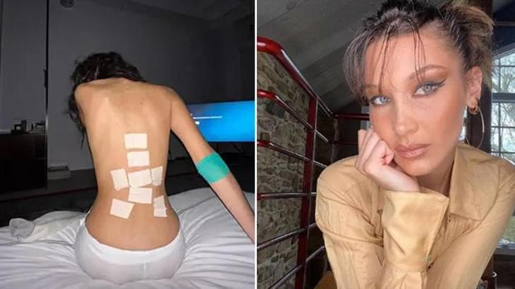 Bella Hadid'in amansız hastalığı: Lyme