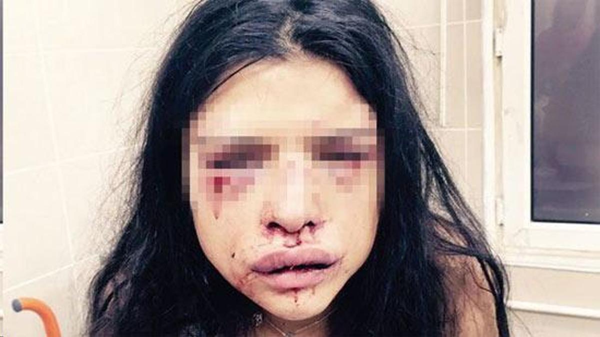 Onur &#214;zbizerdik serbest kaldı, manken sevgilisini hastanelik etti