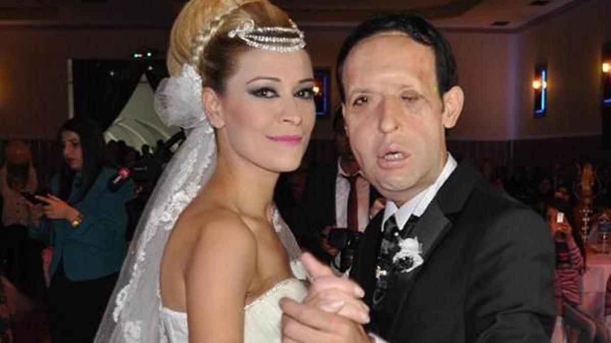 Yüz nakli olan Recep Sert, baba olmaya hazırlanıyor