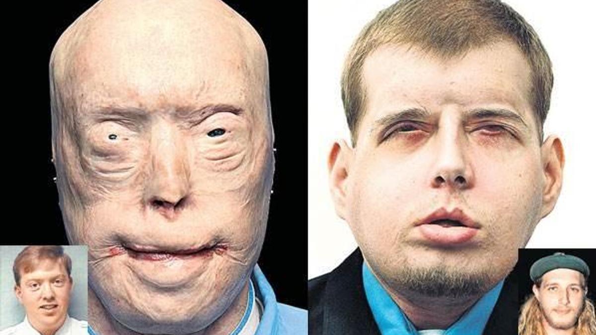 Dünyanın en başarılı yüz nakli