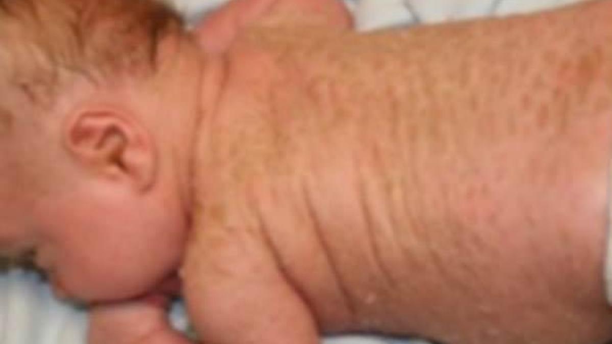 Siirt'te 'yılan bebek' dünyaya geldi