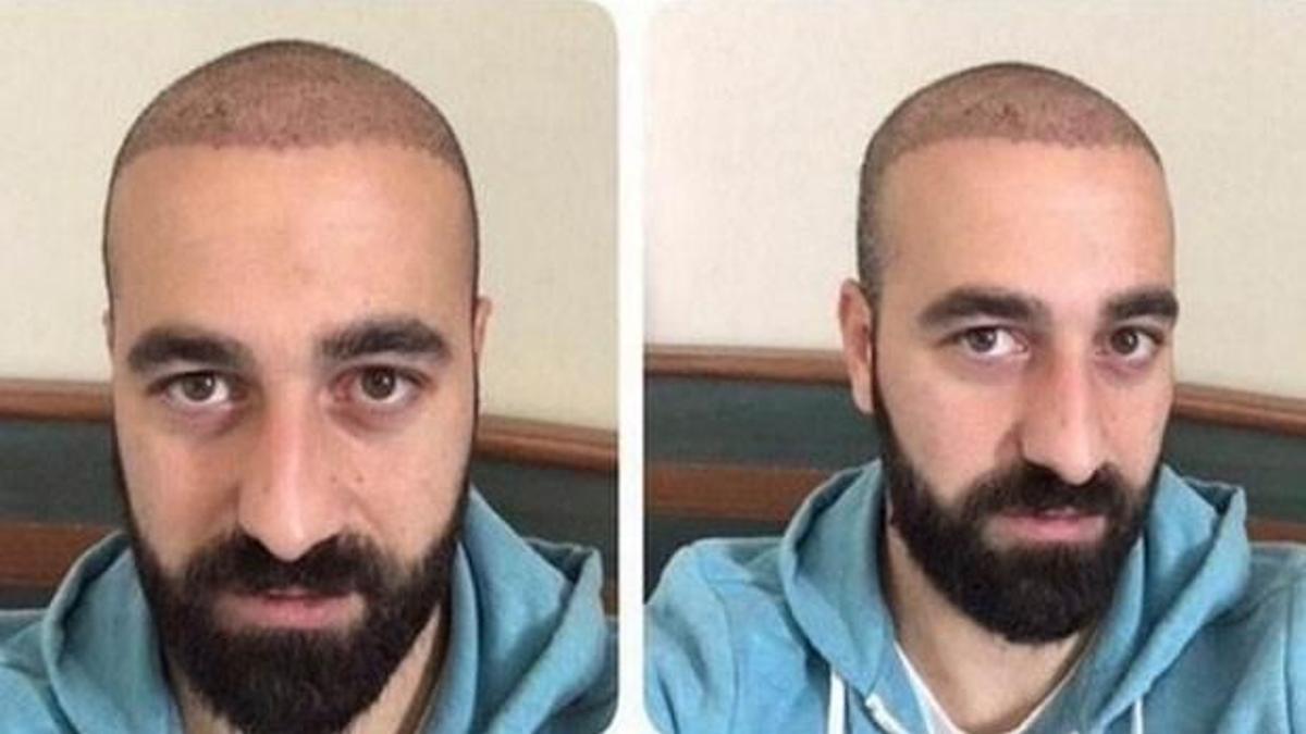 Saç ektirince sözleşmesi feshedildi