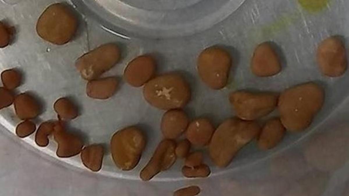 5 aylık bebeğin böbreklerinden 56 taş çıktı