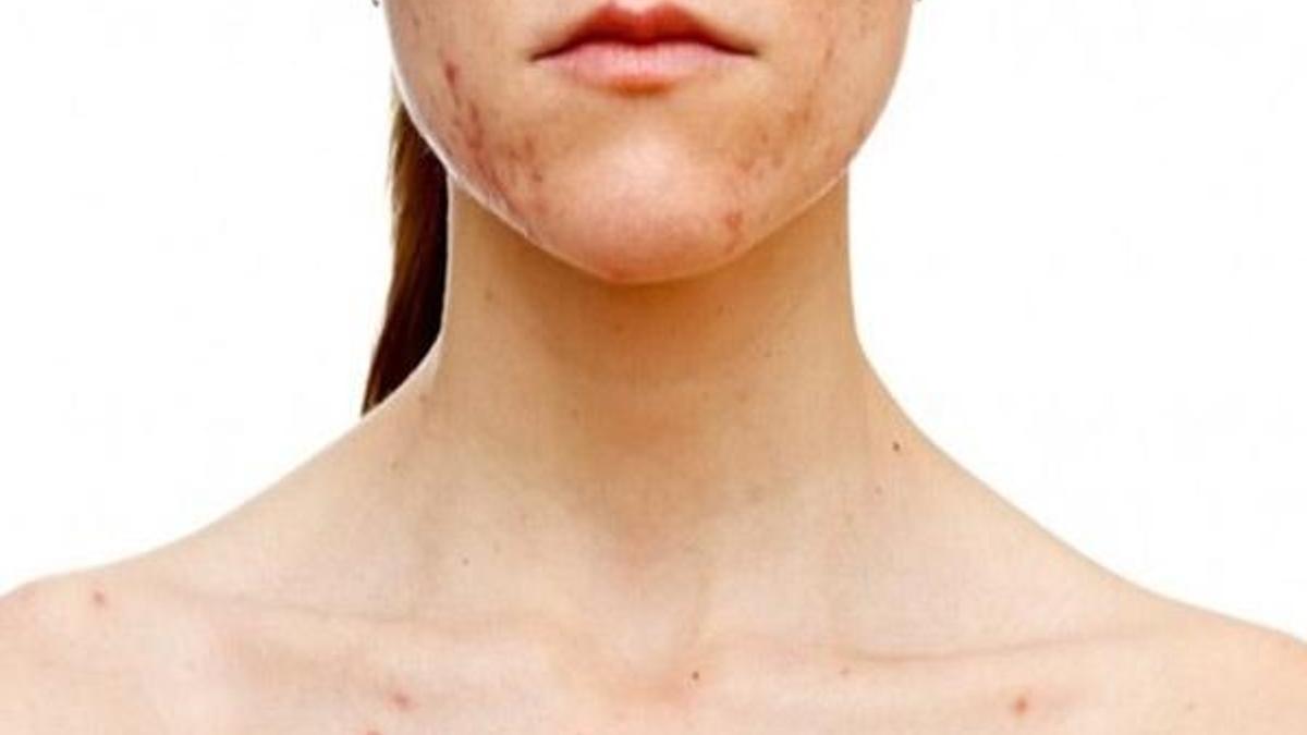 Behçet hastalığı en çok hangi organları etkiliyor?