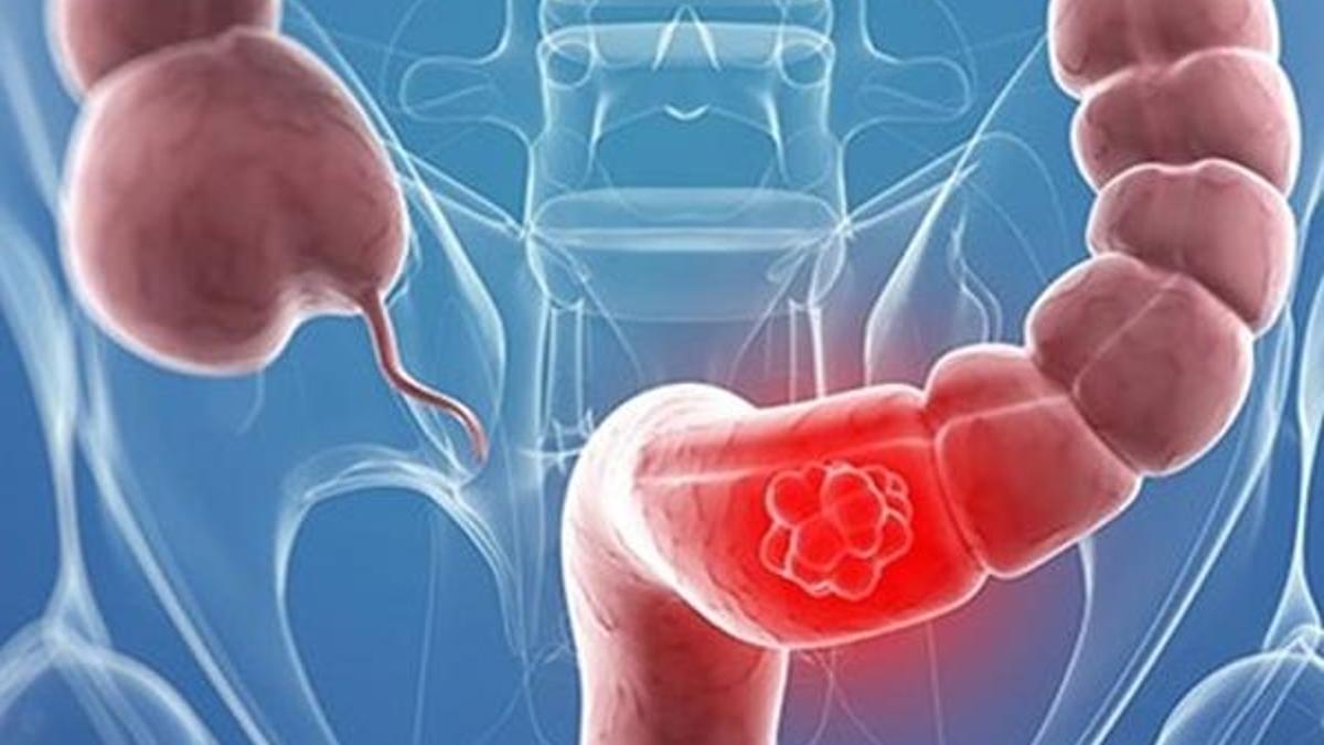 Kalın bağırsak kanserinde erken tanı ölüm oranını azaltıyor