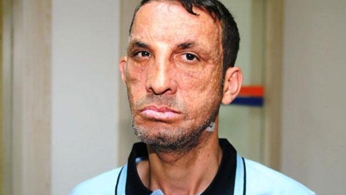 İlk yüz nakilli Uğur Acar'a 'cinayet' davasından beraat