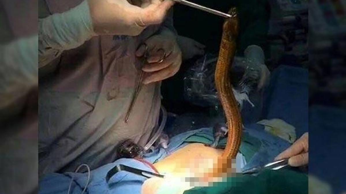Herkes şoka girdi! Anüsünden yılan balığı çıktı