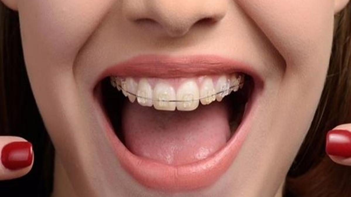 Diş teli temizliği nasıl yapılır?