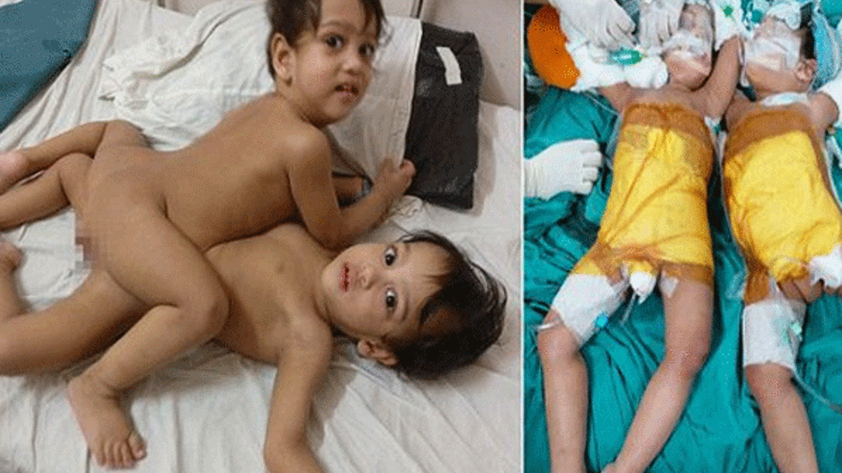 12 saat sürdü, 20 doktor ayırdı!