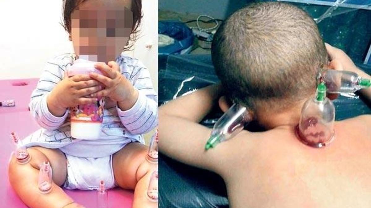 Çocukları bile ‘hacamat’ ettiler