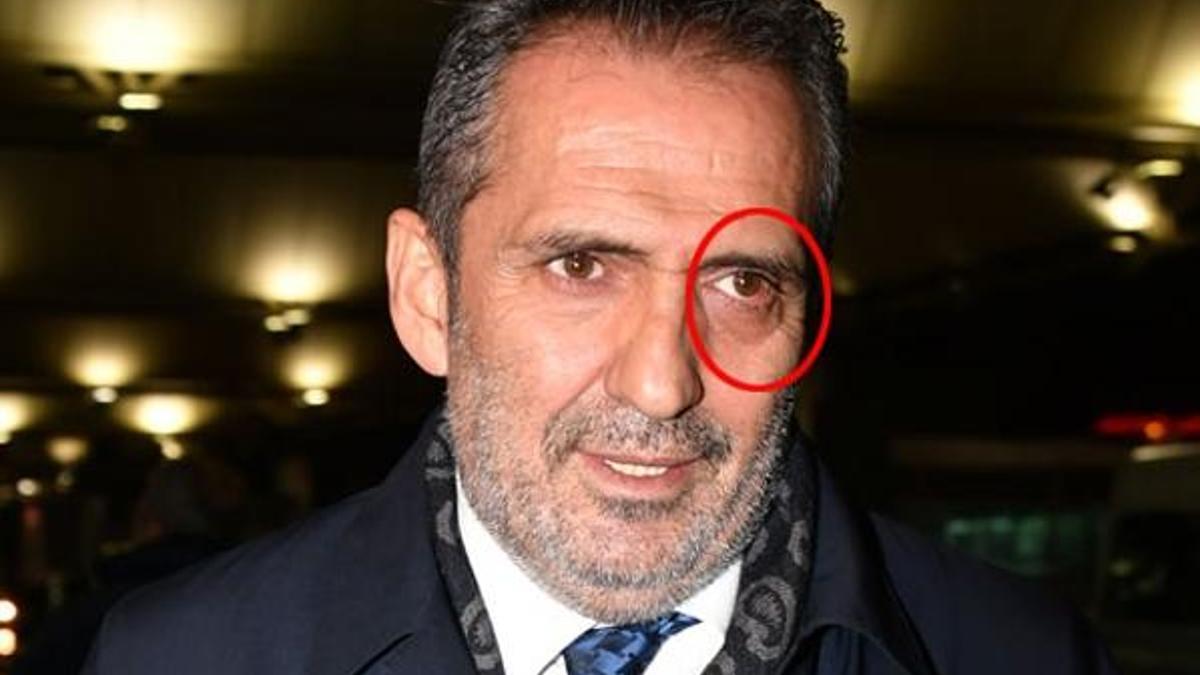 Yavuz Bingöl'ün gözüne ne oldu!