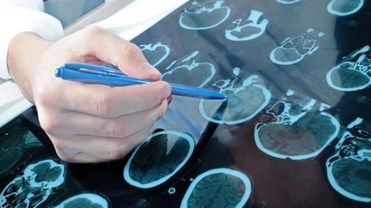 Türkiye'de 10 kişiden 1’i 'epilepsi bulaşıcı' dedi!