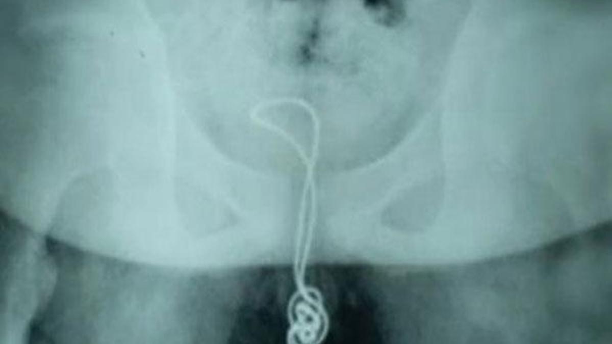 Cinsel organına USB kablosu sıkışan erkek çocuğu hastanelik oldu