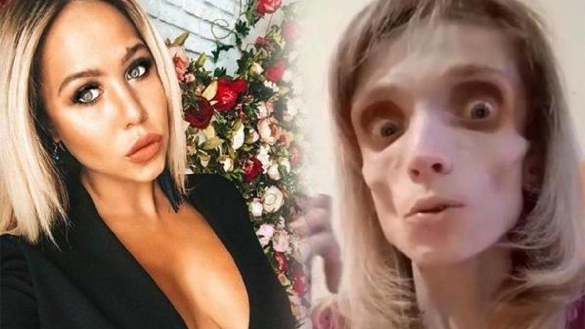 Yıllarca muz ve elma yedi 17 kiloya düştü
