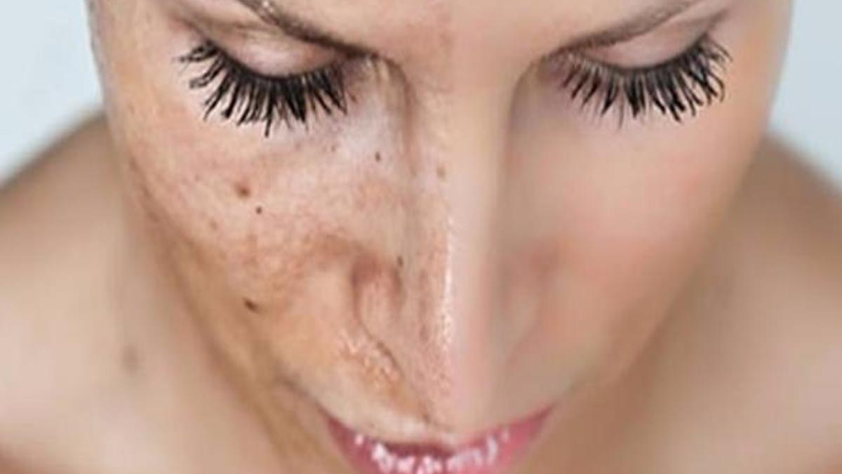 Ciltte oluşan lekelere dikkat