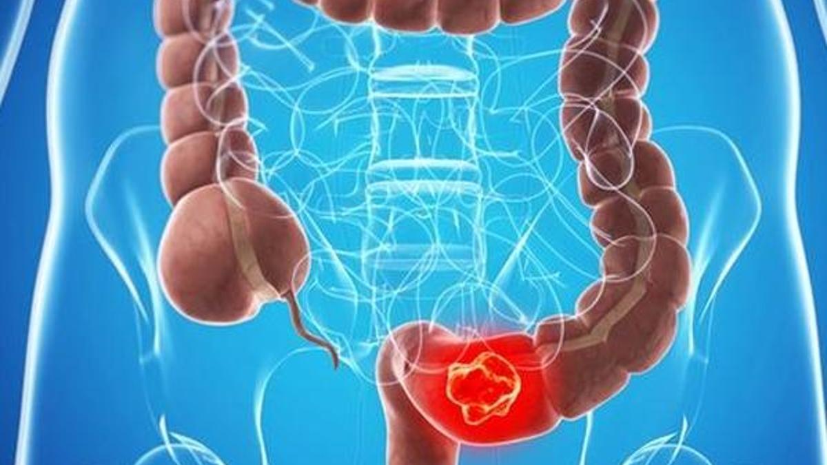 Bu meyve kolon kanseri riskini azaltıyor