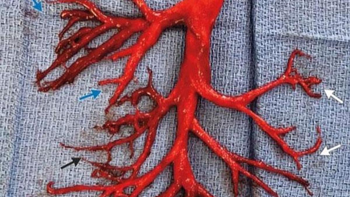 Ağaç dalı şeklinde 15 cm'lik kan pıhtısı tükürdü