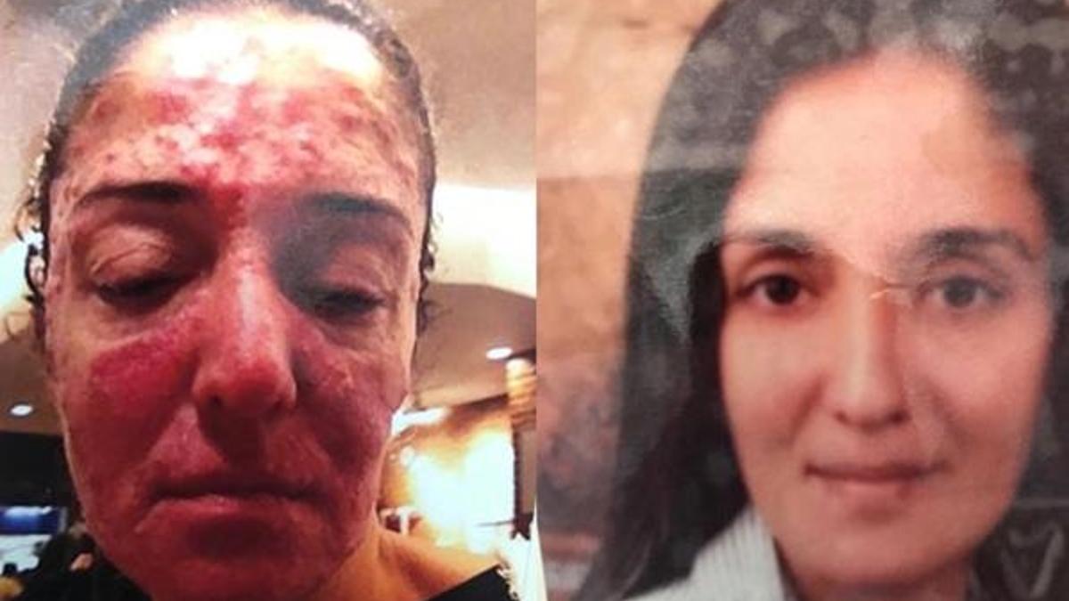 "Yüze kezzap atma soruşturması"nda takipsizlik