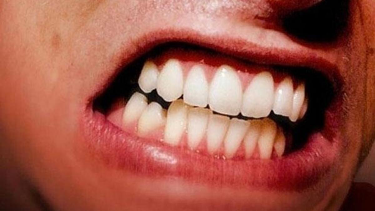 Diş eti çekilmelerinde erken teşhis önemli