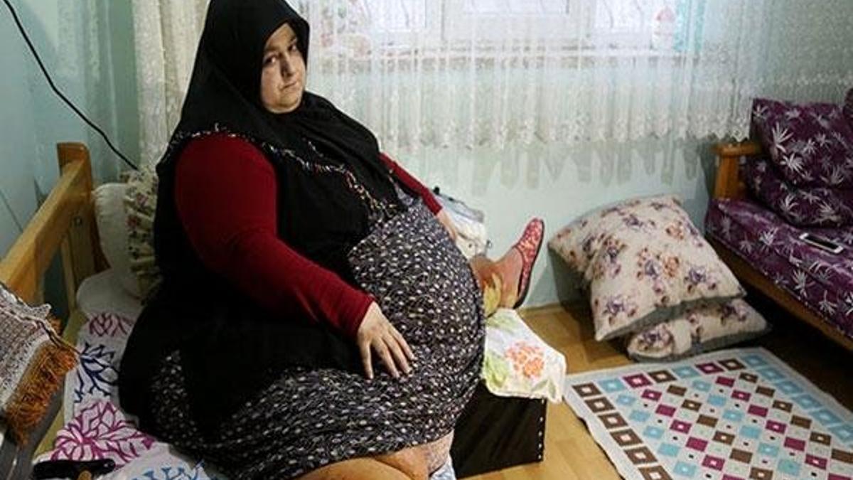 Son hali şoke etti! 1.5 yılda 155 kilo verdi
