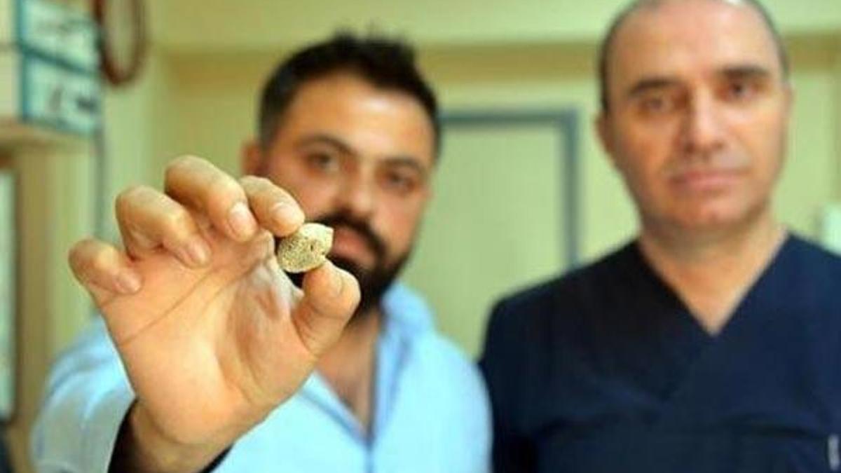 Doktorları bile şaşırttı! 3 santimetre çapında taş