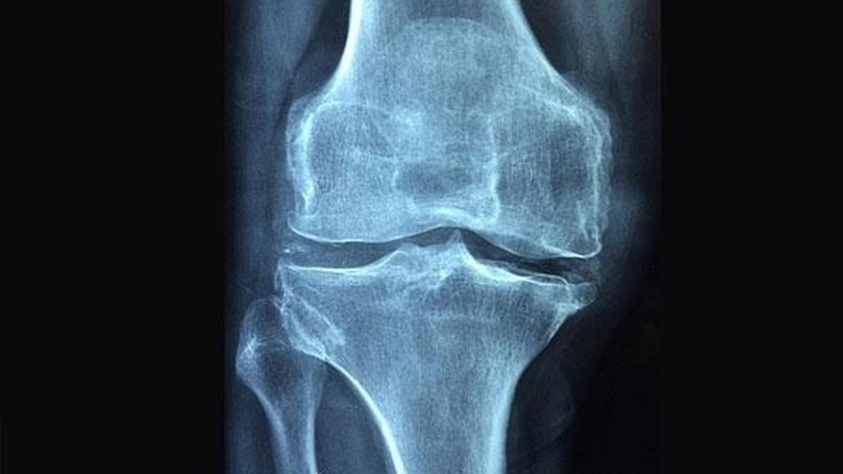 Osteoporoz 3 kadından birini kıskacına alıyor