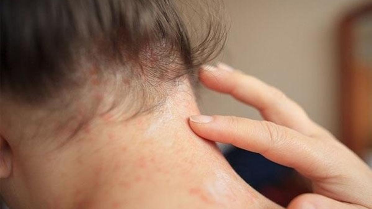 Stres, sigara ve obezite sedef hastalığını tetikliyor