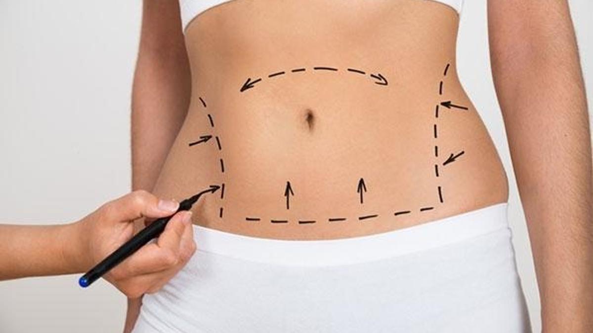 Liposuction zayıflama yöntemi değildir