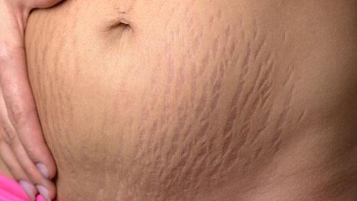 Vücut çatlakları psikolojiyi bozuyor
