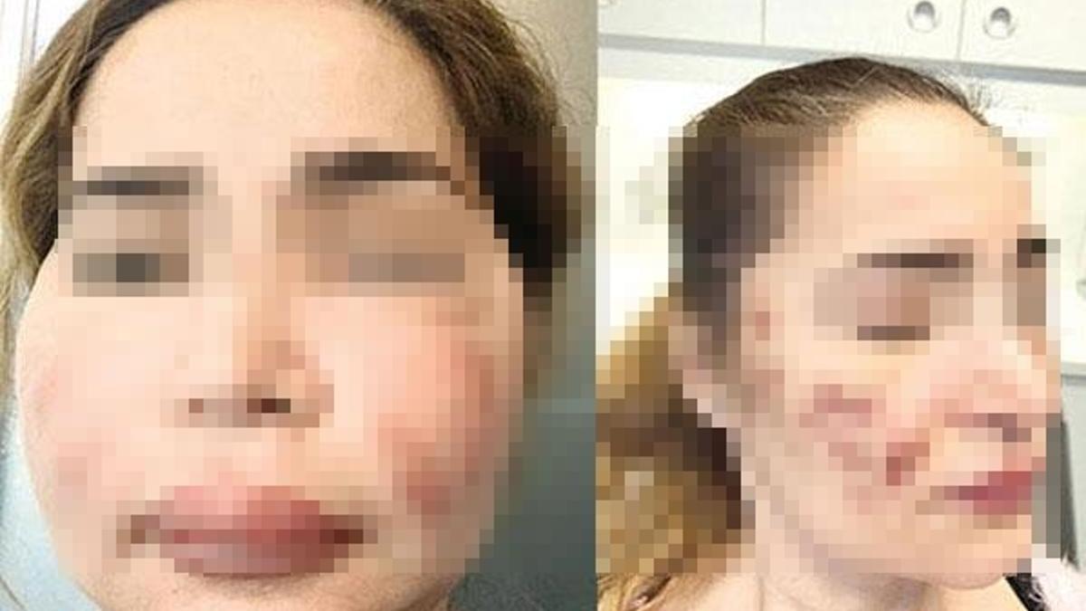 Bir estetik faciası daha! Tanınmaz halde...