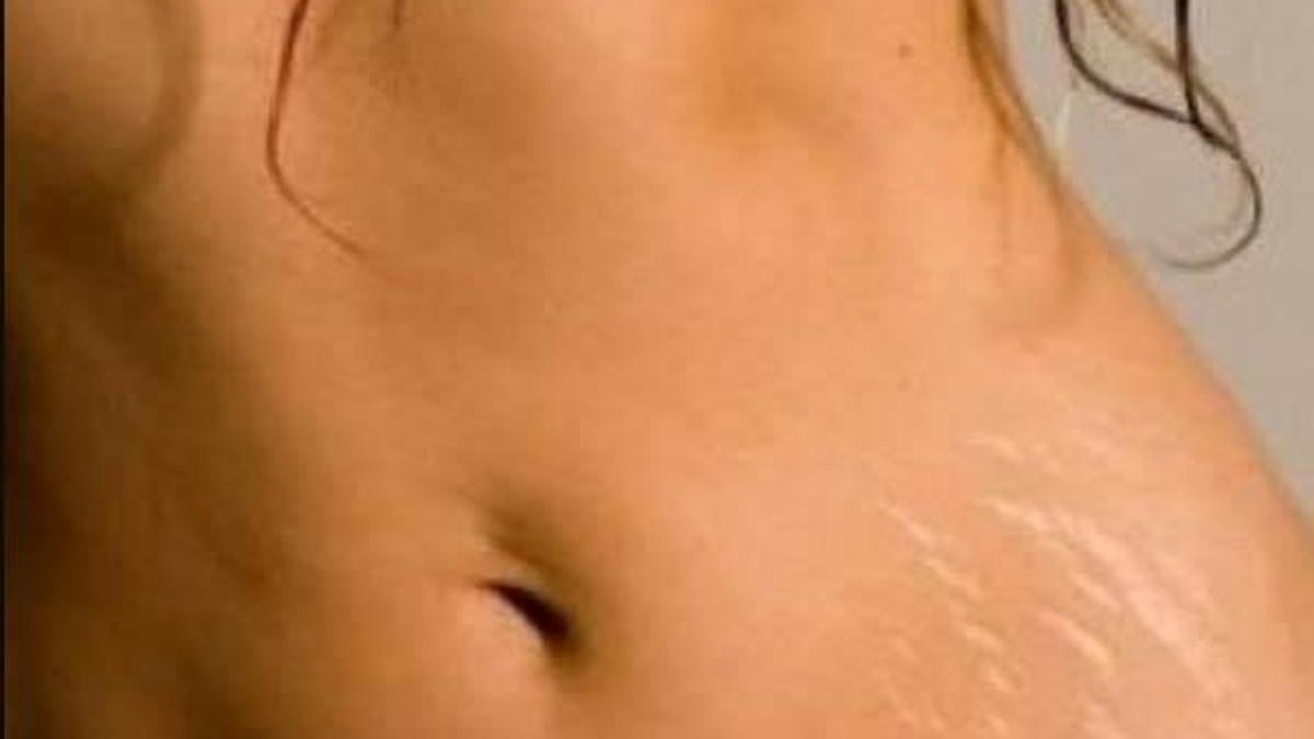 Fibroderms ile vücut çatlaklarına son